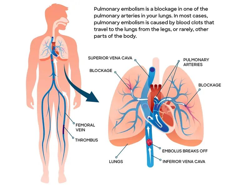 pulmonary embolism diagram