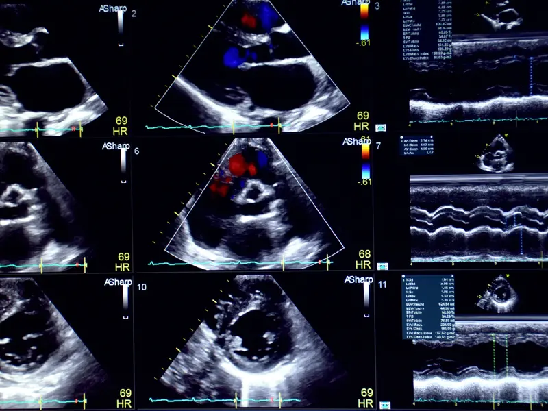 echocardiogram heart ultrasound vs