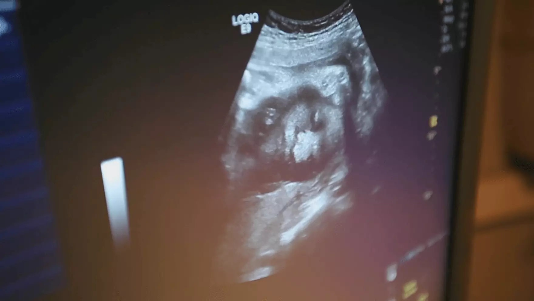 What ultrasounds can tell you about the health of your baby