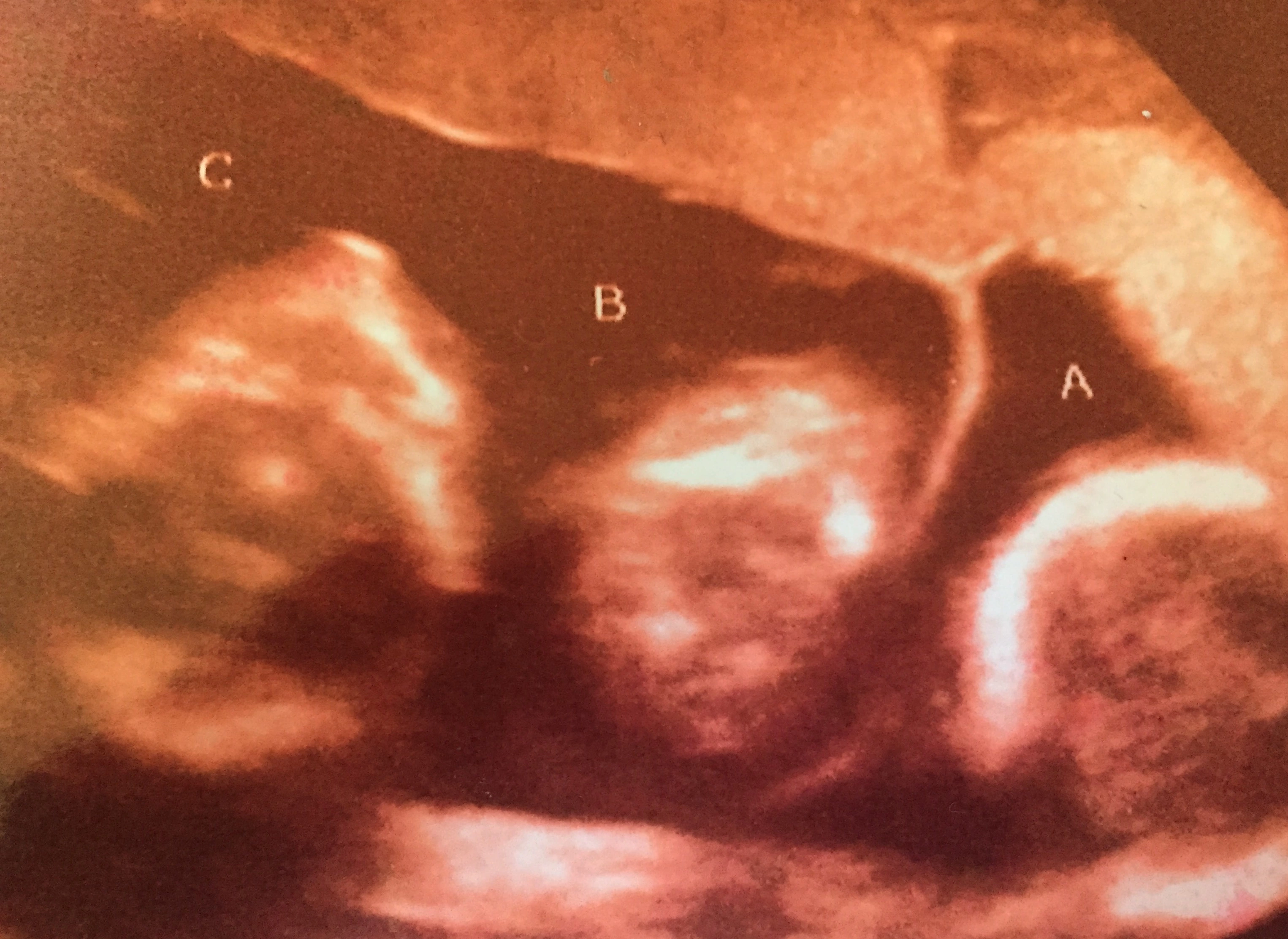Triplets sonogram showing the two amniotic sacs