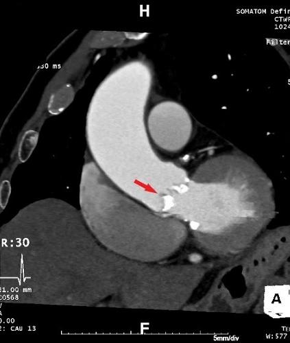 An X-ray showing an aortic valve with a red arrow indicating the diseased part of the valve