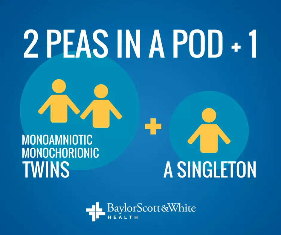 monoamniotic-monochorionic-twins-with-a-singleton